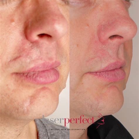 Acne Scar Reduction Laser Perfect