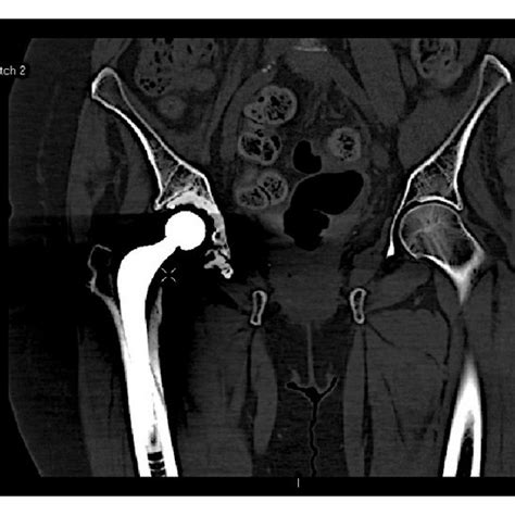 X-ray right femur showing callus formation. | Download Scientific Diagram