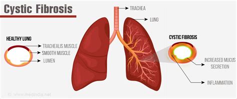 Cystic Fibrosis Signs And Symptoms