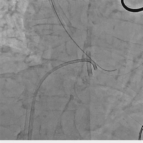 Using the 8-Fr Judkins left catheter to reposition the fractured ...