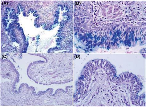 Comparison Of Airway Goblet Cell Hyperplasia In Non‐cystic Fibrosis