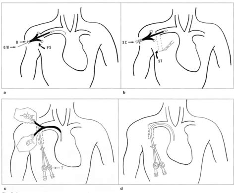 Radiologic Placement Of Tunneled Central Venous Catheter