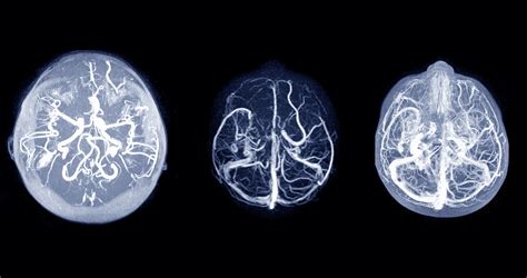 Todo Lo Que Debes Saber Sobre La Trombosis Venosa Cerebral