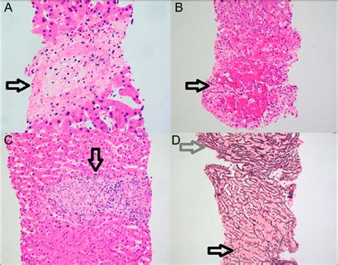 A Focal Central Vein Fibrin Thrombus Arrow B Sinusoidal