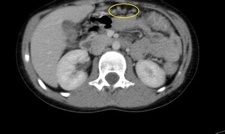 Pseudomembranous Colitis Image Radiopaedia Org