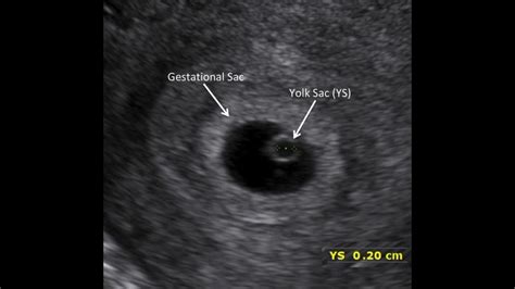 Gestational Sac And Double Decidual Sac Sign Youtube