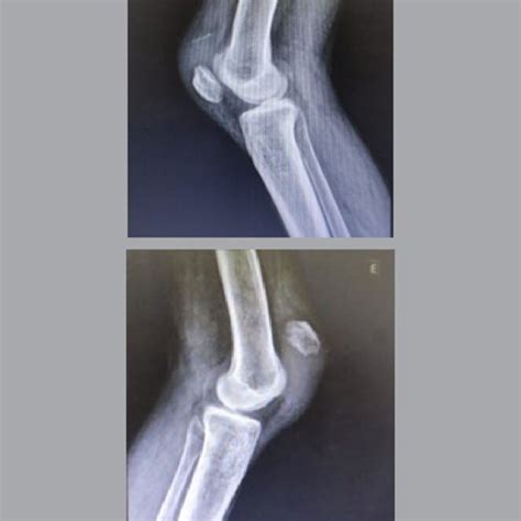 Radiographs Showing Patella Baja On The Right Knee With A