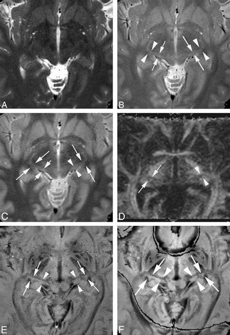 Figure 2 from Visualization of the Medial and Lateral Geniculate ...