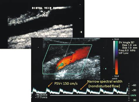 Upper Extremity Arterial Ultrasound