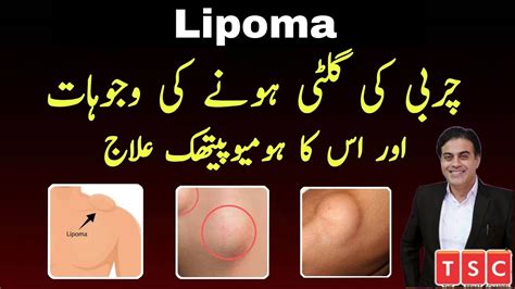 Homeopathic Medicine For Lipoma Charbi Ki Ganth Ka Ilaz How To Cure