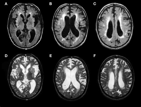 Mri Scan Nhs Mri Scan Brain Scan Mri Brain Images