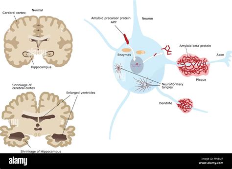 Las Enfermedades Neurodegenerativas Enfermedad De Alzheimer La Sección Del Cerebro Y Las