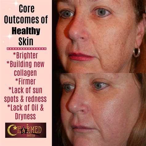 Squaderma skin care results are transforming the beauty industry today 5