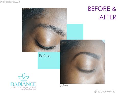 Before After Radiance Medspa Beauty Bar Toronto