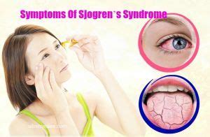 All About Sjogren’s Syndrome Causes, Symptoms, And Cure