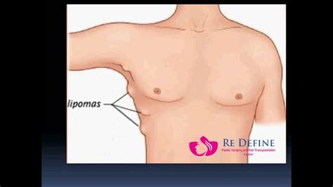 How To Select Best Surgeon For Lipoma Removal In Hyderabad Youtube