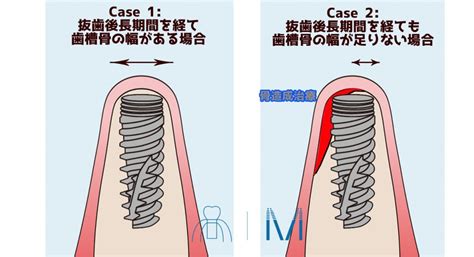 インプラントの術式の違い 即時埋入 待機埋入 即時荷重 待機荷重