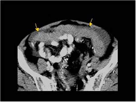 Abdomen And Retroperitoneum 17 Peritoneum Mesentery And Omentum