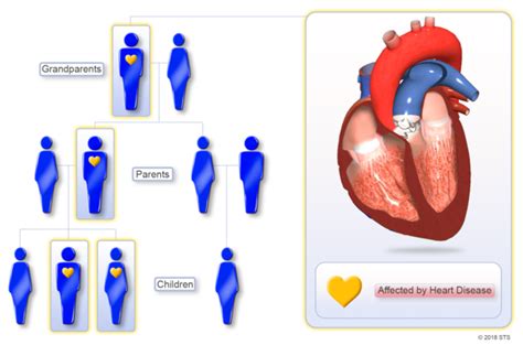 Knowing The Risk Of Myocardial Infarction Heart Attack Through Genetic