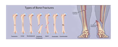 Different Types Of Fractures