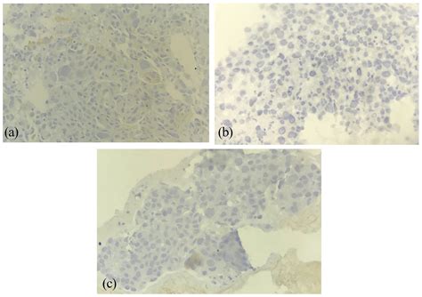 Hepatoid Adenocarcinoma Of The Lung A Rare Form Of Lung Cancer