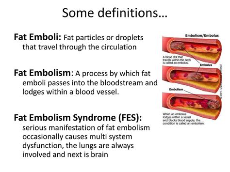 Ppt Fat Embolism Syndrome Fes Powerpoint Presentation Free