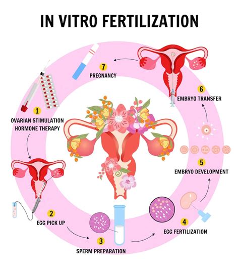 Infografía Del Proceso De Fertilización In Vitro En Vector Vector Premium