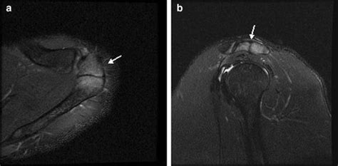 Axial A And Sagittal B T2fs Images Showing The Os Acromiale