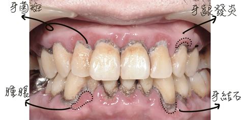 牙結石清除後會流血、牙齦敏感正常嗎？醫：更應該定期洗牙 牙醫大叔愛碎念i黃柏青醫師