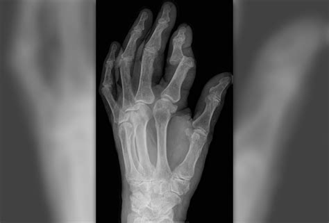 Dislocated finger facts | Musculoskeletal Issues articles | Body & Health Conditions center ...