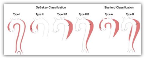 Debakey And Stanford Classifications For Aortic Dissections Lombardi