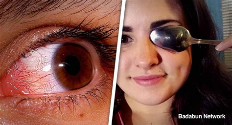 increíbles remedios caseros para los ojos rojos inflamados o