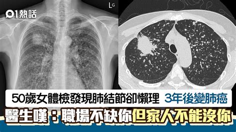 50歲女有肺結節懶理 3年後病情惡化變肺癌 醫生嘆：生命倒數了｜醫師easy