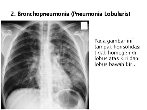 Pneumonia Definisi Pneumonia Adalah Peradangan Alat Parenkim Paru