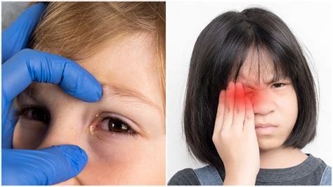 La Conjuntivitis En Niños ¿qué Hacer Y Cómo Tratarla