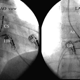 Pdf What Is The Next Step After A Failed Standard Radiofrequency