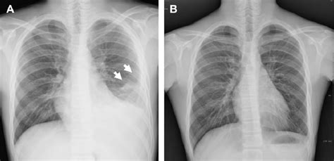 Tb Pleural Effusion