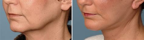 A Study Of The Macs Facelift Explore Plastic Surgery