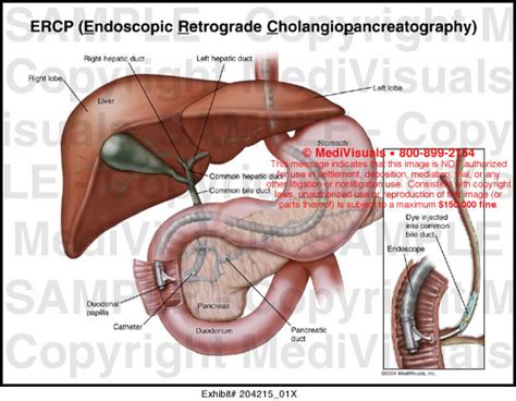 ERCP Endoscopic Retrograde Cholangiopancreatography Medical Exhibit