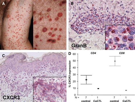 The Role Of Cytotoxic Skin Homing Cd8 Lymphocytes In Cutaneous Cytotoxic T Cell Lymphoma And