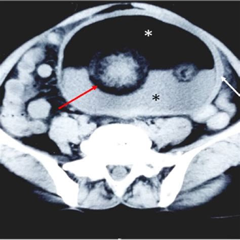 Well Defined Large Pelvic Thick Walled Cystic Lesion Not Clearly Download Scientific Diagram