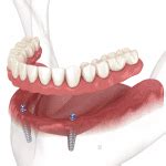 Permanent Dentures Types Pros Cons Costs Teeth Wisdom