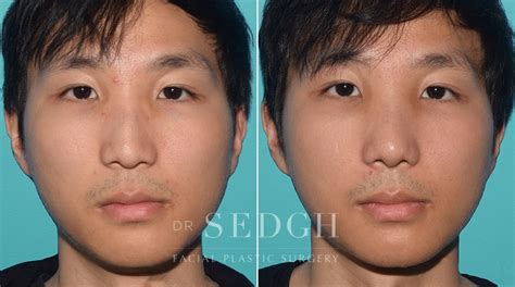 Asian Rhinoplasty Before And After Photos Dr Sedgh