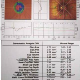 A. OCT examination of optic nerve head of the B. OCT examination of ...