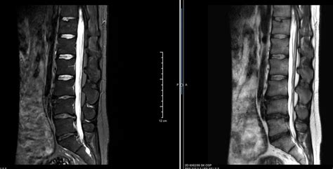 Disc Desiccation & Loss of Disc Height - L3-L4, L4-L5, L5-S1. 27 y/o ...