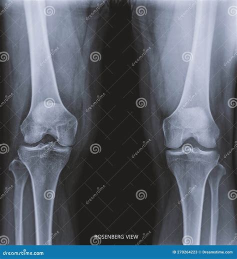 Film X-ray Both Knee Joint AP View Name is Rosenberg View for Diagnosis ...