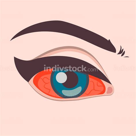 Eye Irritation Inflamed Bloodshot Eyeball With Red Conjunctiva