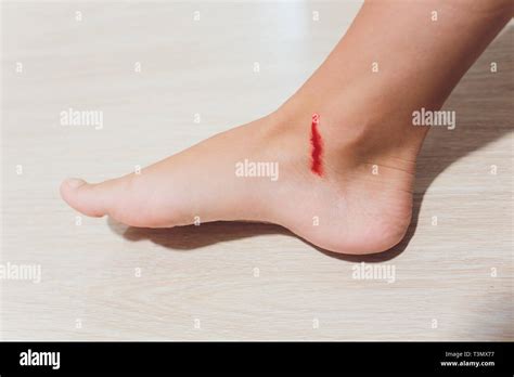 Incised Wound Hi Res Stock Photography And Images Alamy