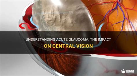 Understanding Acute Glaucoma: The Impact On Central Vision | MedShun