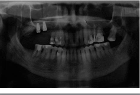 Figure 6 from LEVANTAMIENTO DEL SENO MAXILAR TÉCNICA VENTANA LATERAL